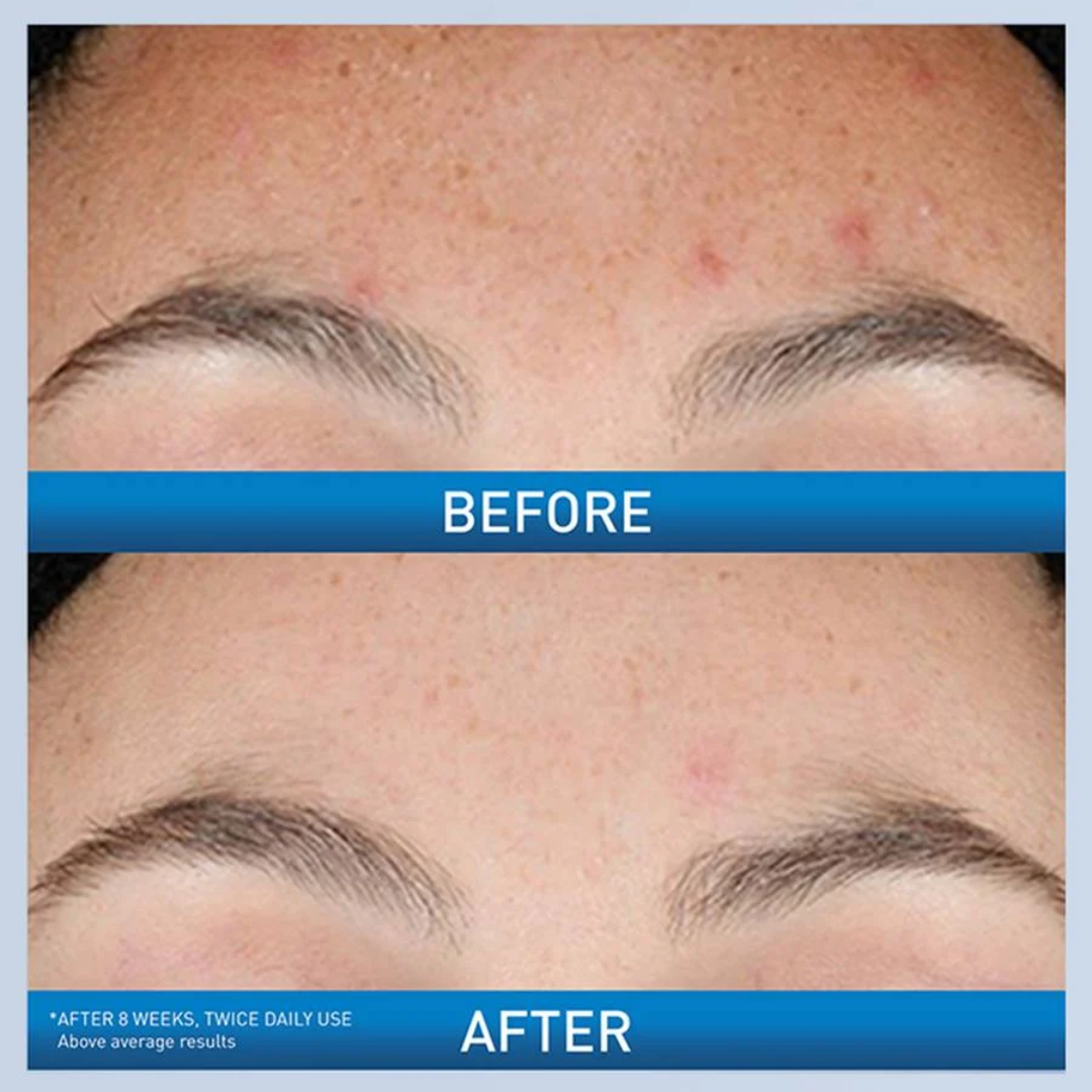 https://cdn.shopify.com/s/files/1/1291/3633/files/beforeandafterofCeraVeResurfacingRetinolSerumForPost-AcneMarks.png?v=1759742789